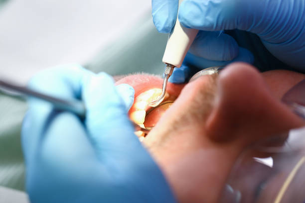 Best Emergency Treatment for Dental Infections or Abscesses in Western Lake, TX